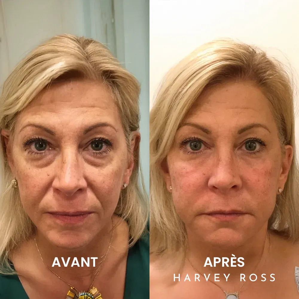 Harvey Ross - Instant Lift+